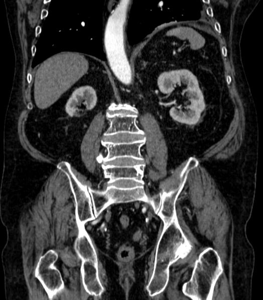 File:Abdominal aortic aneurysm (Radiopaedia 25855-26001 Coronal C+ arterial phase 50).jpg