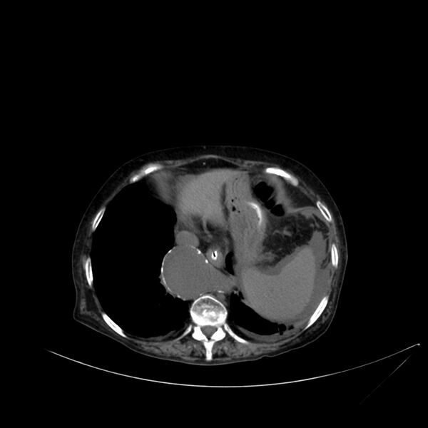 File:Abdominal aortic aneurysm - impending rupture (Radiopaedia 19233-19246 Axial non-contrast 22).jpg