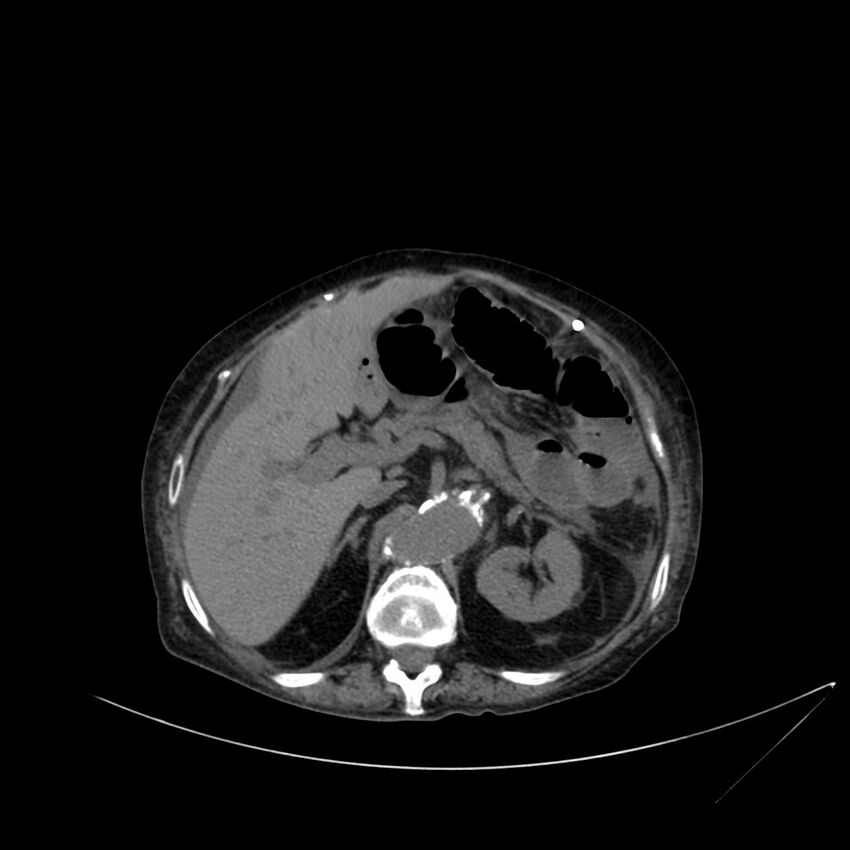 Abdominal aortic aneurysm - impending rupture (Radiopaedia 19233-19246 Axial non-contrast 40).jpg
