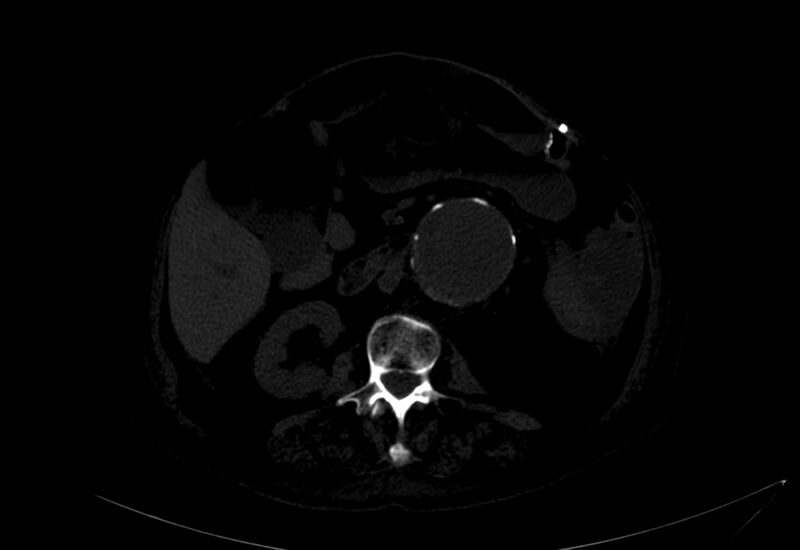 File:Abdominal aortic aneurysm - impending rupture (Radiopaedia 19233-19246 B 13).jpg