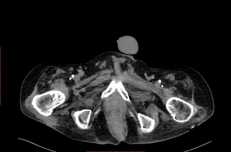 File:Abdominal aortic interposition tube graft and aneurysm thrombosis (Radiopaedia 71438-81857 Axial C+ arterial phase 262).jpg