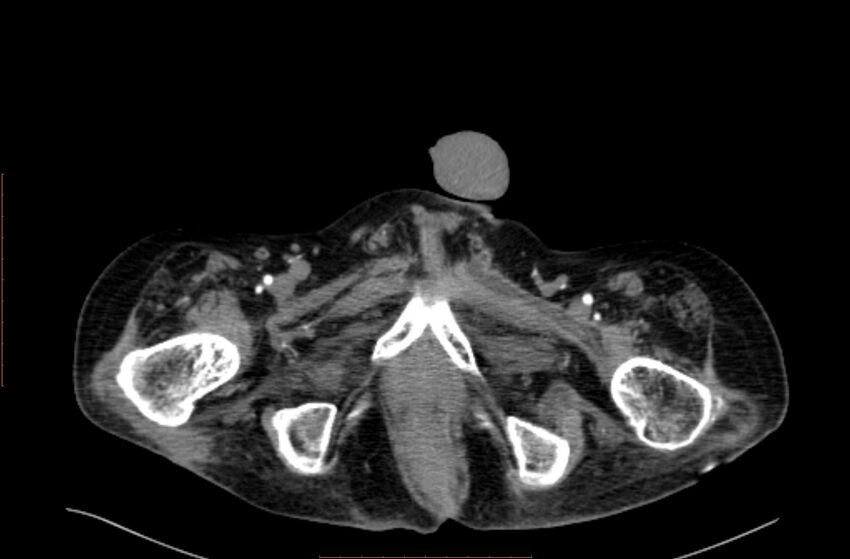 Abdominal aortic interposition tube graft and aneurysm thrombosis (Radiopaedia 71438-81857 Axial C+ arterial phase 262).jpg
