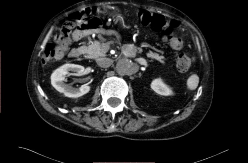 File:Abdominal aortic interposition tube graft and aneurysm thrombosis (Radiopaedia 71438-81857 Axial C+ arterial phase 46).jpg
