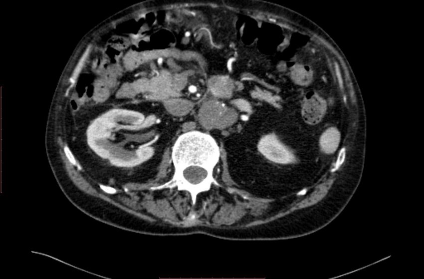 Abdominal aortic interposition tube graft and aneurysm thrombosis (Radiopaedia 71438-81857 Axial C+ arterial phase 46).jpg