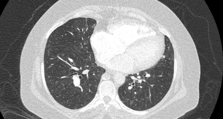 Accessory right inferior hepatic vein (Radiopaedia 65245-74259 Axial lung window 49).jpg