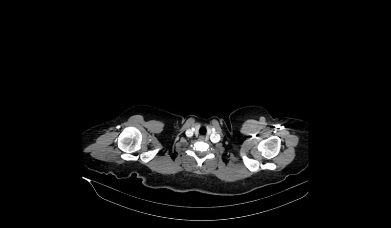File:Acquired tracheo-esophageal fistula (Radiopaedia 51356-57103 Axial C+ arterial phase 1).jpg