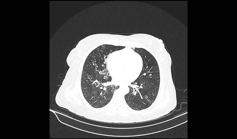 File:Acquired tracheo-esophageal fistula (Radiopaedia 51356-57103 Axial lung window 26).jpg