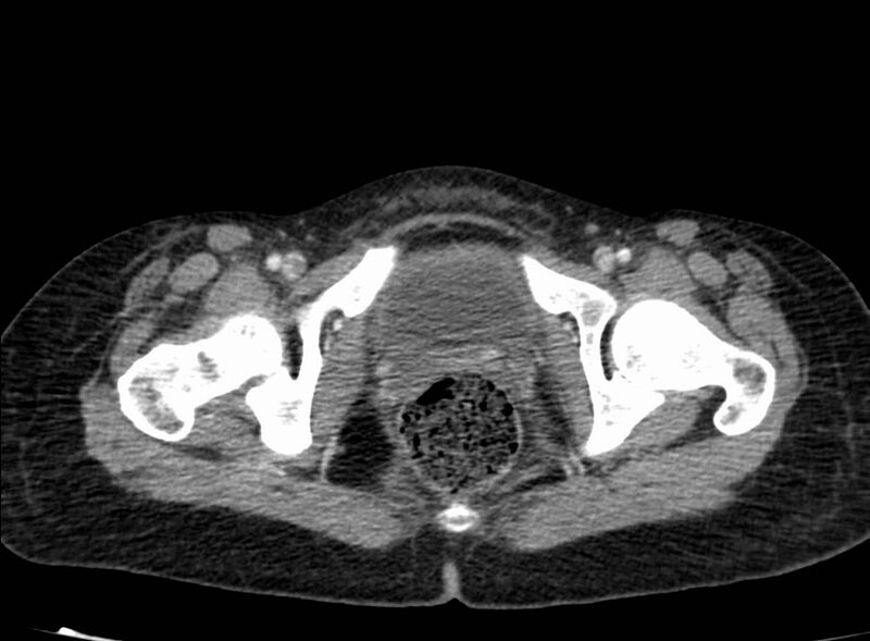File:Acute Budd-Chiari syndrome (Radiopaedia 60858-68638 Axial C+ portal venous phase 293).jpg