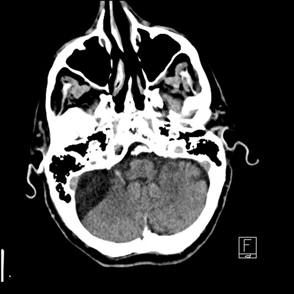 File:Acute ICA ischemic penumbra due to high-grade CCA stenosis (CT perfusion) (Radiopaedia 72038-82529 Axial non-contrast 8).jpg