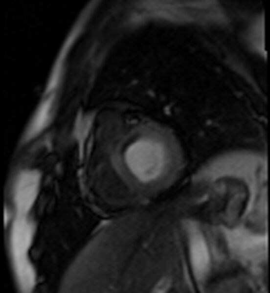 File:Acute anteroseptal myocardial infarction (Radiopaedia 68409-77945 Short axis (basal) Perfusion 14).jpg