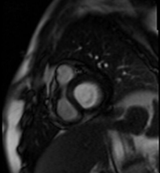 File:Acute anteroseptal myocardial infarction (Radiopaedia 68409-77945 Short axis (basal) Perfusion 9).jpg