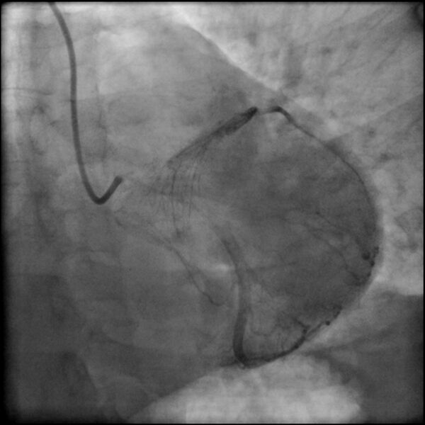 File:Acute anteroseptal myocardial infarction (Radiopaedia 68409-77946 LAO caudal (spider view) LAD and CX 56).jpg