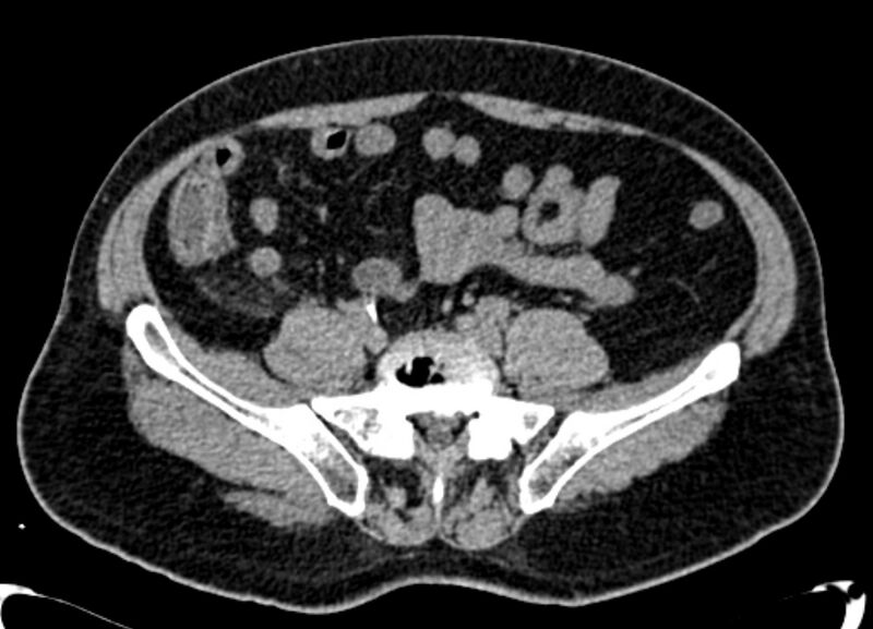 File:Acute appendicitis (Radiopaedia 13030-13091 Axial non-contrast 18).jpg