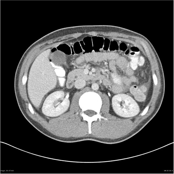 File:Acute appendicitis (Radiopaedia 25364-25615 B 22).jpg