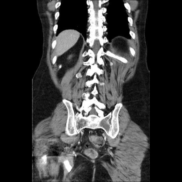 File:Acute cholecystitis and incidental left sided IVC (Radiopaedia 49352-54459 Coronal C+ portal venous phase 18).jpg