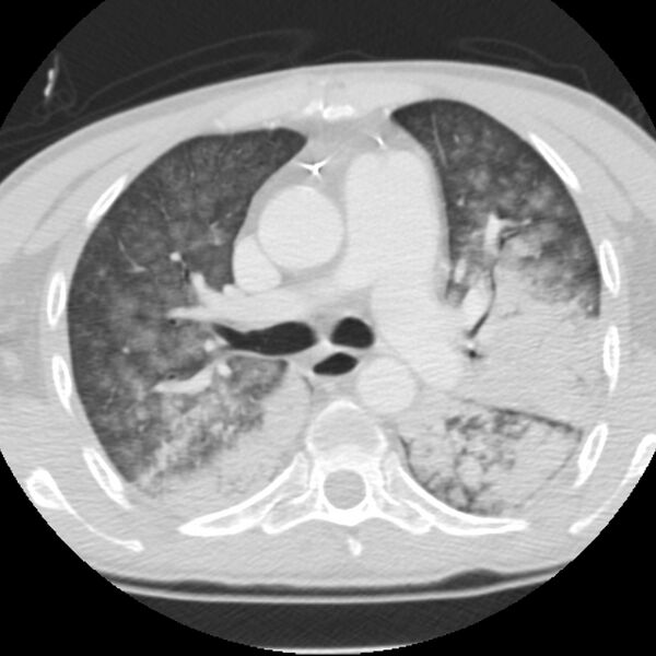 File:Acute diffuse alveolar hemorrhage (Radiopaedia 41323-44158 Axial lung window 22).jpg