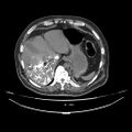 Acute heart failure (CT) (Radiopaedia 79835-93075 Axial C+ arterial phase 70).jpg