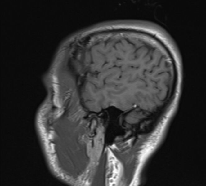 File:Acute ischemic stroke - posterior circulation territory (Radiopaedia 77670-89880 Sagittal T1 2).jpg