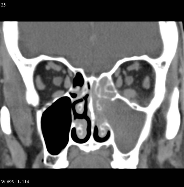File:Acute maxillary sinusitis (Radiopaedia 4890-6825 Coronal non-contrast 1).jpg