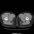 Acute myocarditis (Radiopaedia 55988-62613 Axial C+ portal venous phase 94).jpg
