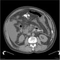 Acute pancreatitis (Radiopaedia 19135-19116 Axial non-contrast 23).jpg