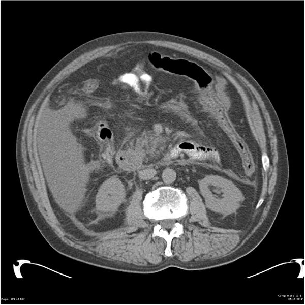 File:Acute pancreatitis (Radiopaedia 19135-19116 Axial non-contrast 23).jpg
