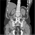 Acute pancreatitis (Radiopaedia 19135-19116 Coronal non-contrast 36).jpg