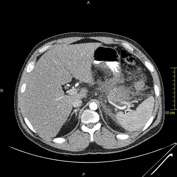 File:Acute pancreatitis (Radiopaedia 23231-23290 Axial C+ arterial phase 10).JPG