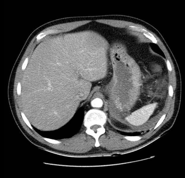 File:Acute pancreatitis - Balthazar E (Radiopaedia 23080-23110 Axial C+ arterial phase 13).jpg