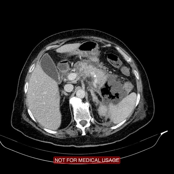 File:Acute pancreatitis with infected necrosis (Radiopaedia 26454-26585 Axial C+ portal venous phase 6).jpg