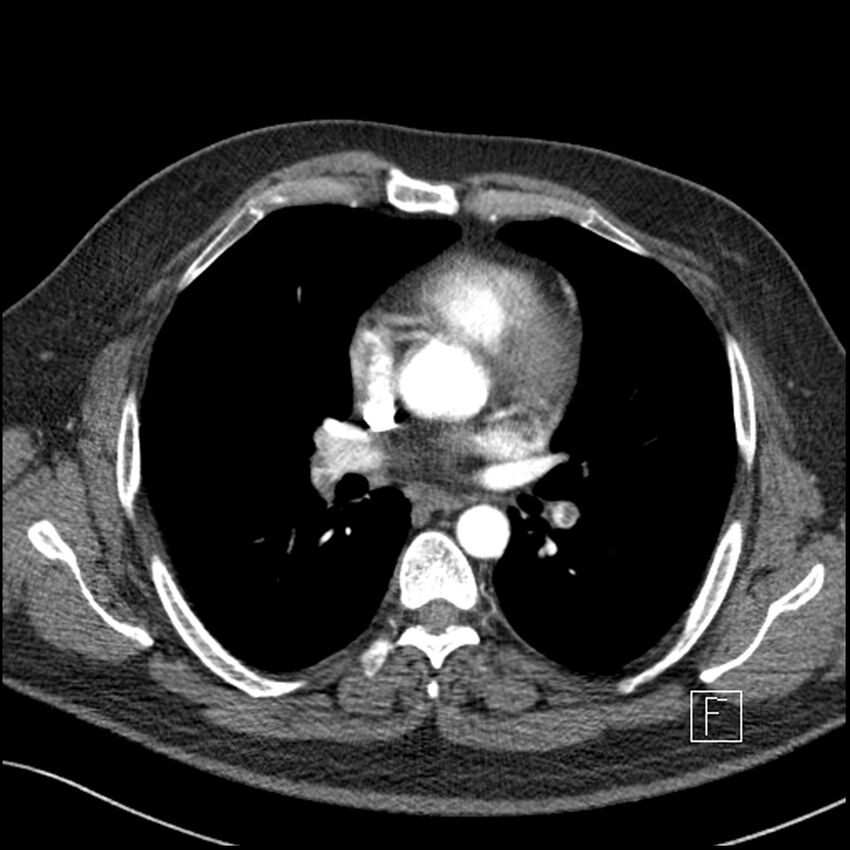 Acute pulmonary embolism with pulmonary infarct (Radiopaedia 73062-83768 Axial C+ CTPA 38).jpg