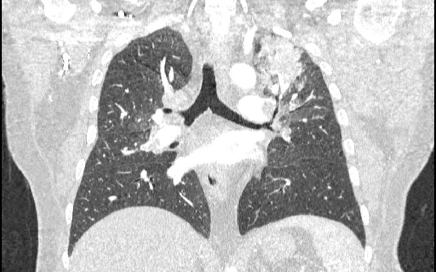 Acute pulmonary embolism with pulmonary infarcts (Radiopaedia 77688-89908 Coronal lung window 55).jpg