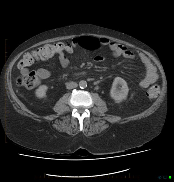 File:Acute renal failure post IV contrast injection- CT findings (Radiopaedia 47815-52557 Axial non-contrast 43).jpg