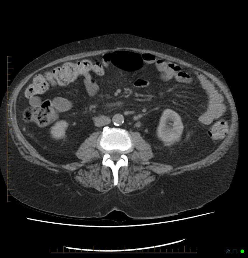 Acute renal failure post IV contrast injection- CT findings (Radiopaedia 47815-52557 Axial non-contrast 43).jpg