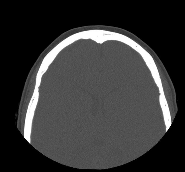 File:Acute sinusitis (Radiopaedia 22419-22455 Axial non-contrast 36).jpg