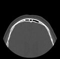 Acute sinusitis (Radiopaedia 23161-23215 Axial bone window 79).jpg