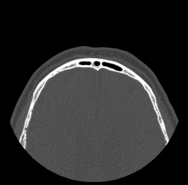 File:Acute sinusitis (Radiopaedia 23161-23215 Axial bone window 79).jpg