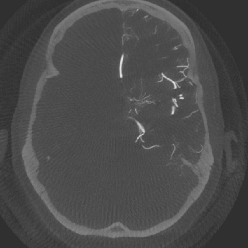 Acute subarachnoid hemorrhage and accessory anterior cerebral artery (Radiopaedia 69231-79010 C 25).jpg