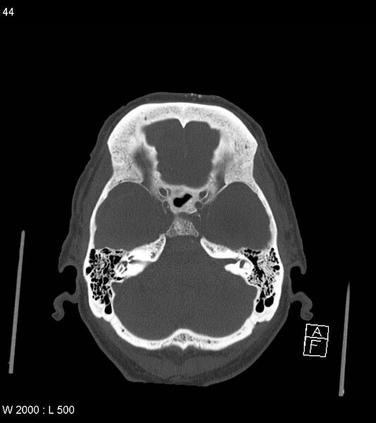 File:Acute subdural hematoma with myelofibrosis (Radiopaedia 52582-58494 Axial bone window 22).jpg
