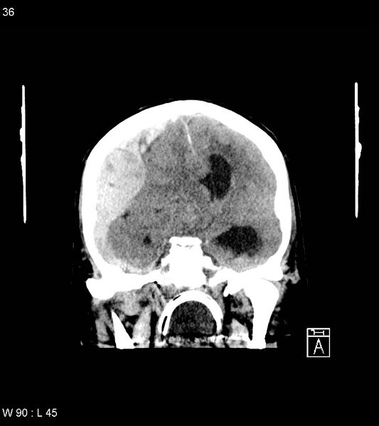File:Acute subdural hematoma with myelofibrosis (Radiopaedia 52582-58494 Coronal non-contrast 27).jpg