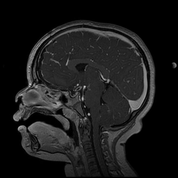 File:Adamantinomatous craniopharyngioma (Radiopaedia 77407-89529 H 63).jpg