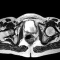 Adenomyoma of the uterus (huge) (Radiopaedia 9870-10438 Axial T2 9).jpg