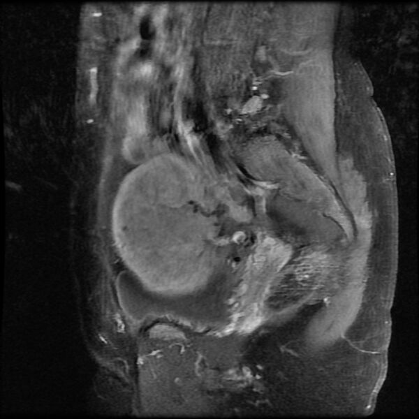 File:Adenomyosis on MRI (Radiopaedia 29328-29780 Sagittal T1 C+ fat sat 4).jpg