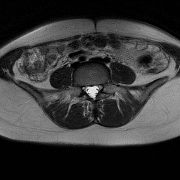 File:Adenomyosis within a septate uterus (Radiopaedia 69963-79981 Axial T2 5).jpg