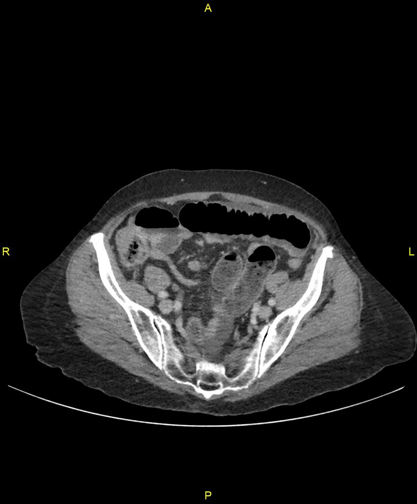 Adhesional small bowel obstruction (Radiopaedia 85402-101024 Axial C+ portal venous phase 219).jpg