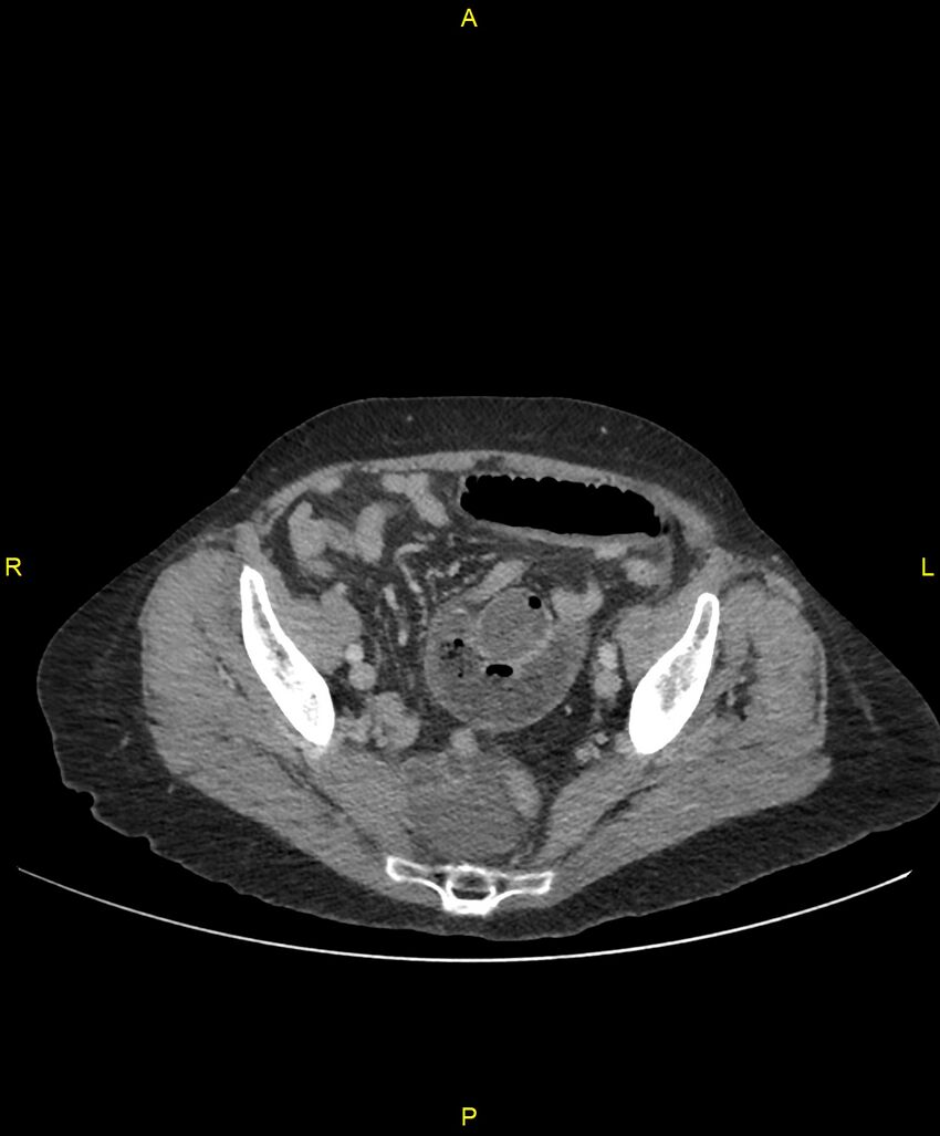 Adhesional small bowel obstruction (Radiopaedia 85402-101024 Axial C+ portal venous phase 234).jpg