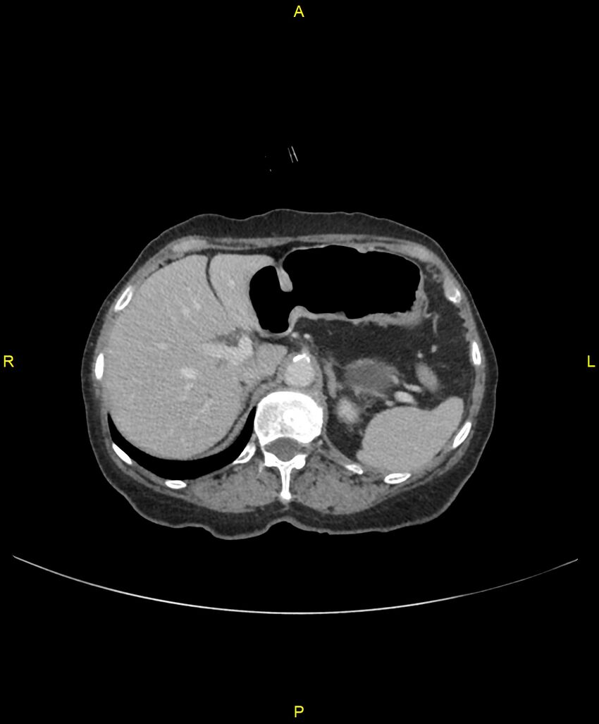 Adhesional small bowel obstruction (Radiopaedia 85402-101024 Axial C+ portal venous phase 72).jpg