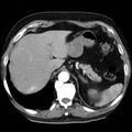 Adrenal hemangioma (Radiopaedia 11039-11445 Axial C+ arterial phase 2).jpg