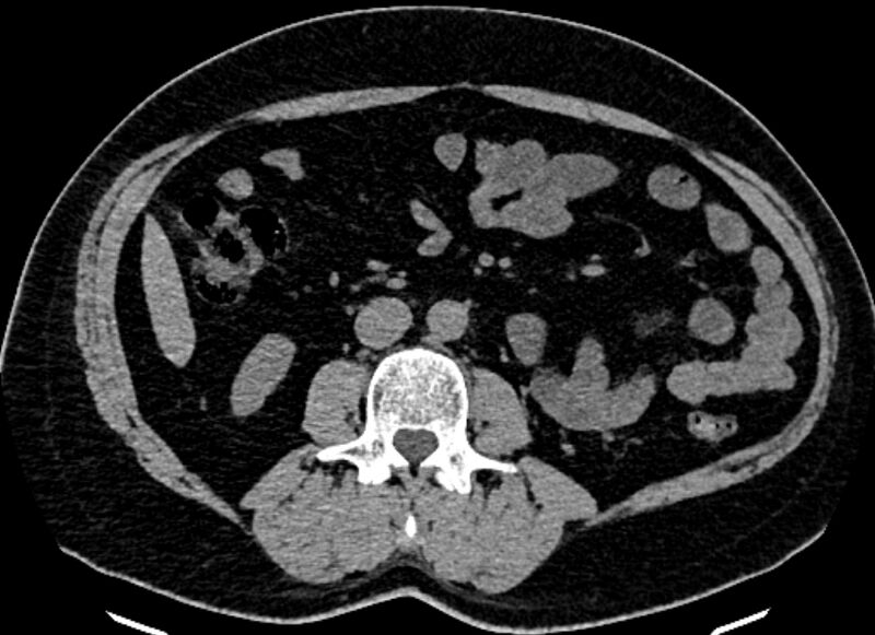 File:Adrenal metastases (Radiopaedia 73082-83791 Axial non-contrast 99).jpg