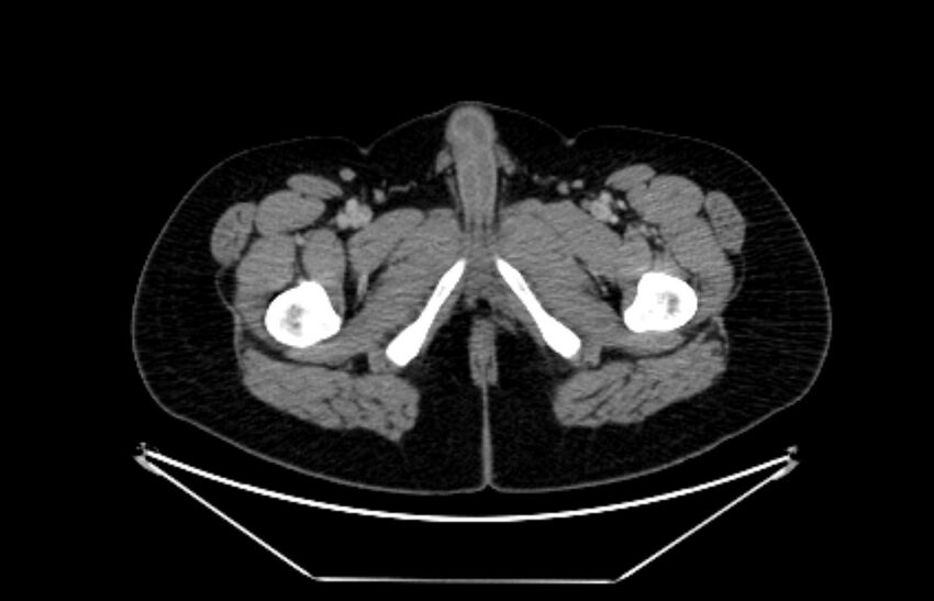 Adrenocortical carcinoma (Radiopaedia 80134-93438 Axial C+ portal venous phase 142).jpg